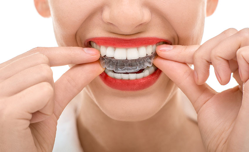 Como Funciona o Invisalign