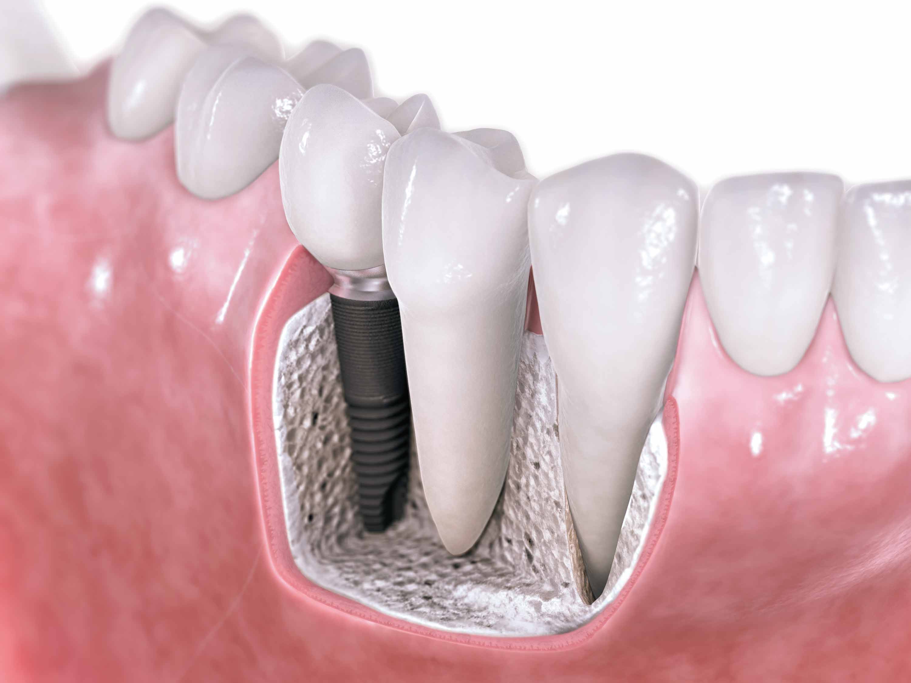 Implante Dentário